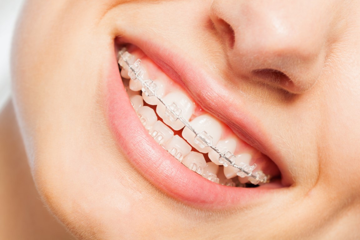 Unveiling the Magic of Clear Braces: Your Complete Guide to a Perfect Smile